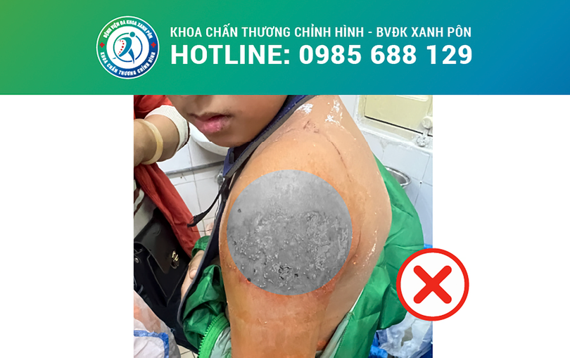 Bệnh viện đa khoa Xanh Pôn (Hà Nội) cảnh báo nguy hiểm tính mạng đối với người bệnh khi điều trị gãy xương bằng bó lá.