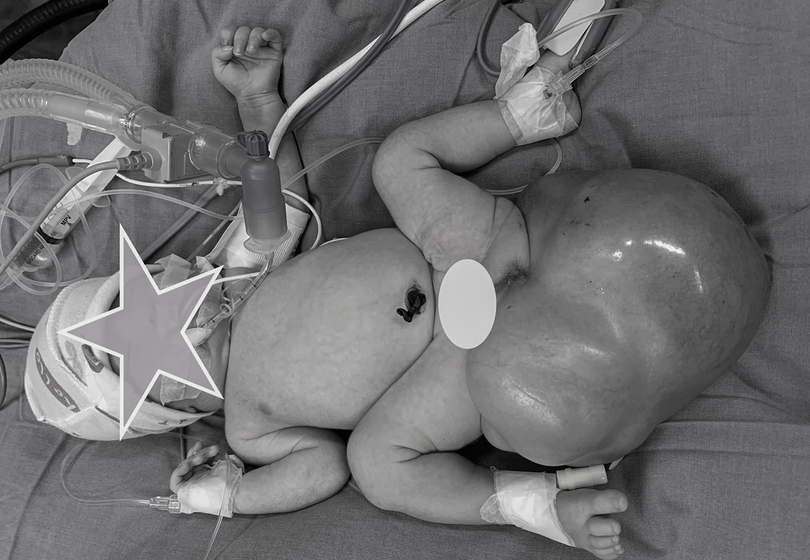 Bé gái 5 ngày tuổi mắc khối u nặng hơn 1,2kg được phát hiện từ trong bào thai mẹ. (Ảnh BVCC)