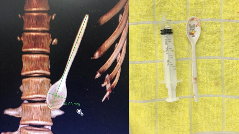 Hình ảnh thìa nhựa bên trong đường tiêu hoá của bệnh nhân từ phim chụp và sau khi lấy ra ngoài