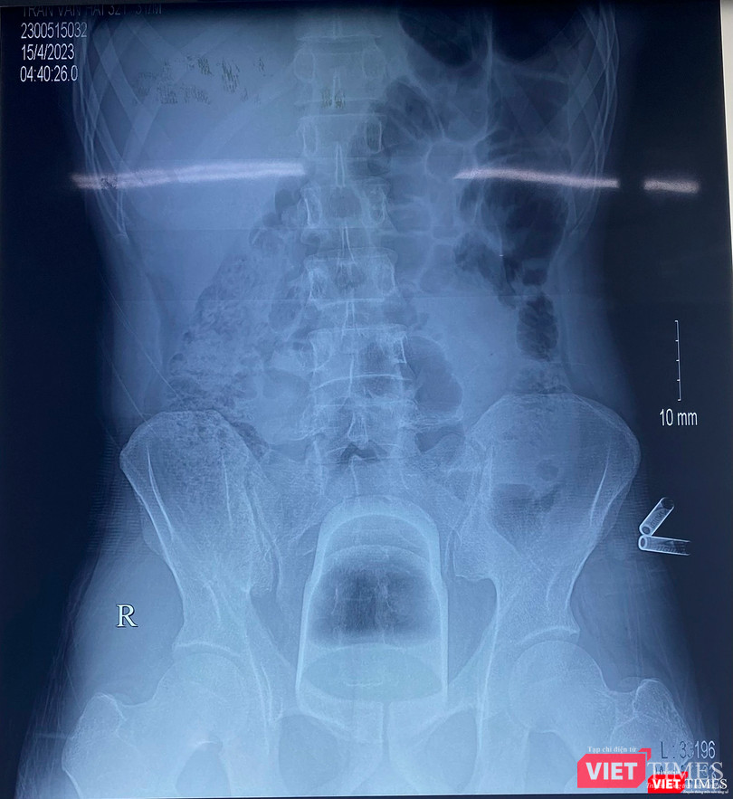 Phim X-quang chiếc cốc đánh răng nằm sâu trong trực tràng của bệnh nhân (ảnh BVCC)