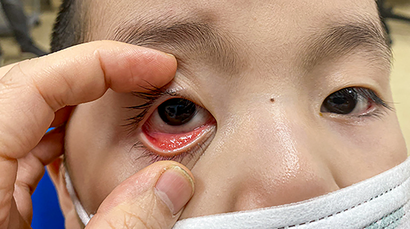 Người mắc bệnh đau mắt đỏ tuyệt đối không tự ý sử dụng các thuốc nhỏ mắt có chứa corticoid (ảnh BV Nhi TW)