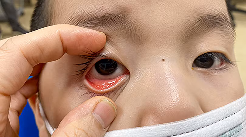 Dịch đau mắt đỏ đang có xu hướng gia tăng tại nhiều tỉnh thành trên cả nước