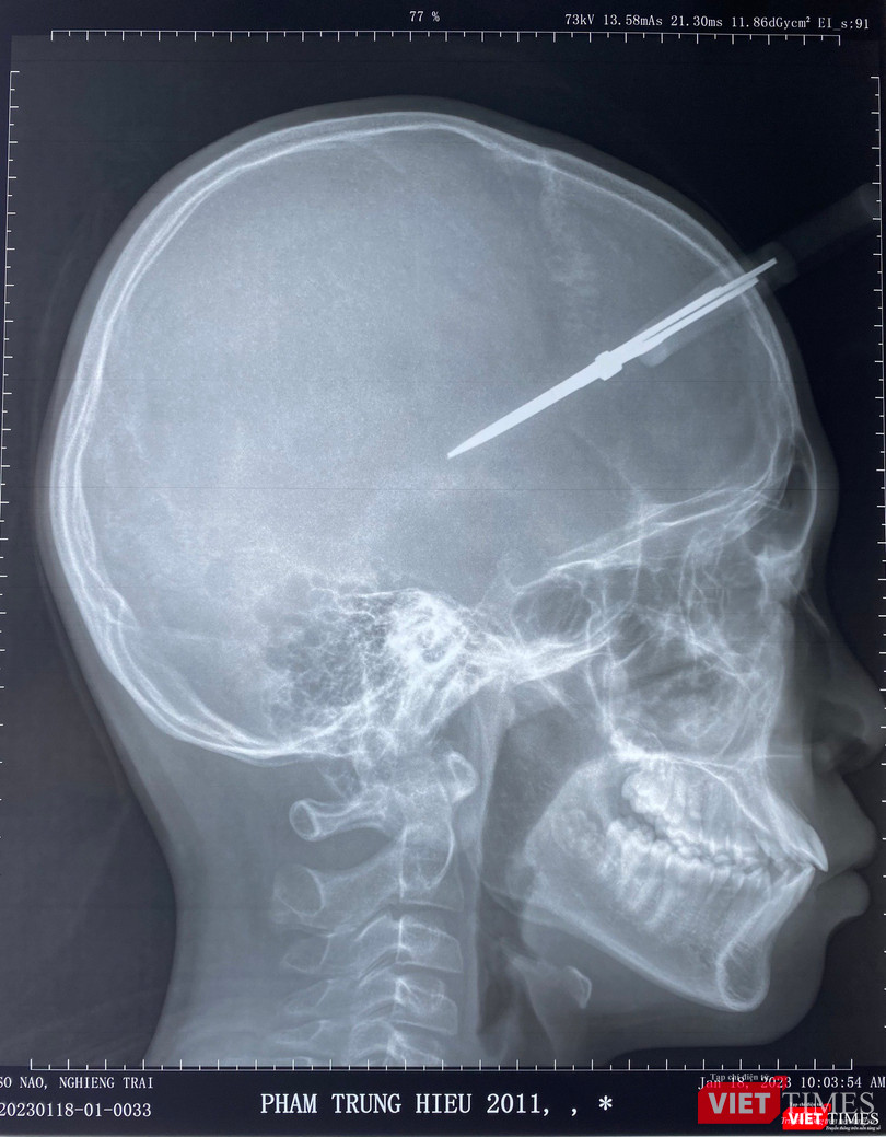 Phim chụp hộp sọ bệnh nhân và chiếc kéo cắm vào thái dương Phim chụp hộp sọ bệnh nhân và chiếc kéo cắm vào thái dương