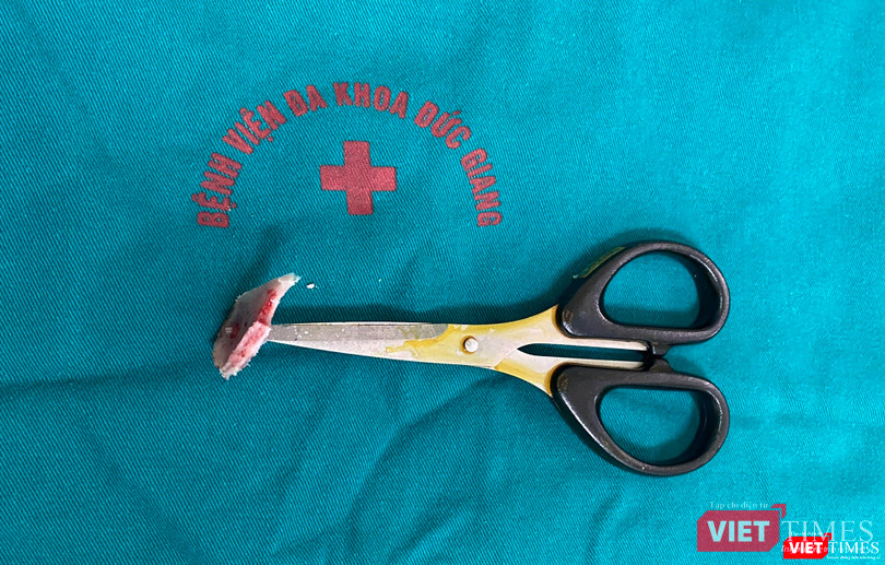 Mảnh sọ cùng chiếc kéo đâm thủng được lấy ra sau ca phẫu thuật Mảnh sọ cùng chiếc kéo đâm thủng được lấy ra sau ca phẫu thuật