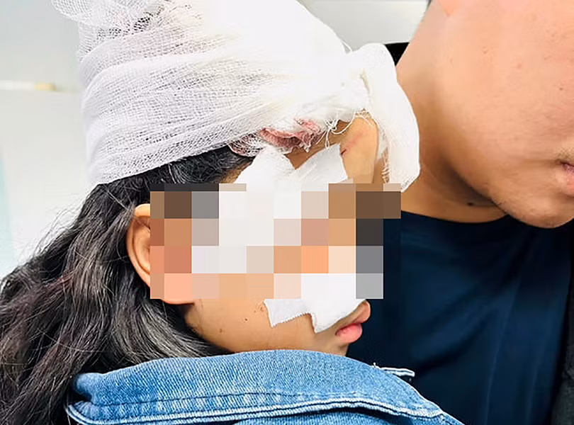 Một trường hợp bệnh nhi bị chó cắn phải nhập viện (Ảnh BVCC)