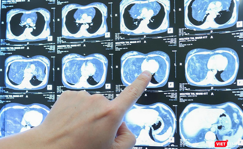 Hình ảnh khối u khổng lồ trong khoang ngực của bệnh nhân M.