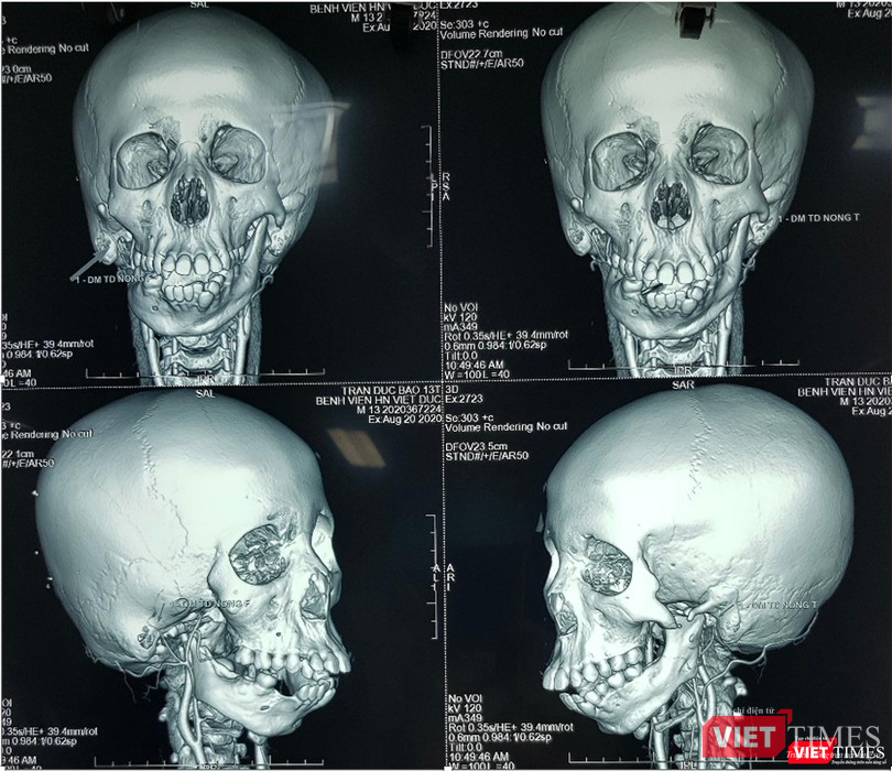 Hình ảnh CT 3D cho phép chẩn đoán xác định mức độ thiểu sản và teo lép nửa mặt ở hội chứng tai hàm Hình ảnh CT 3D cho phép chẩn đoán xác định mức độ thiểu sản và teo lép nửa mặt ở hội chứng tai hàm