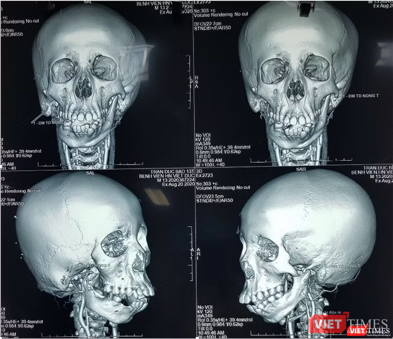 Hình ảnh CT 3D cho phép chẩn đoán xác định mức độ thiểu sản và teo lép nửa mặt ở hội chứng tai hàm