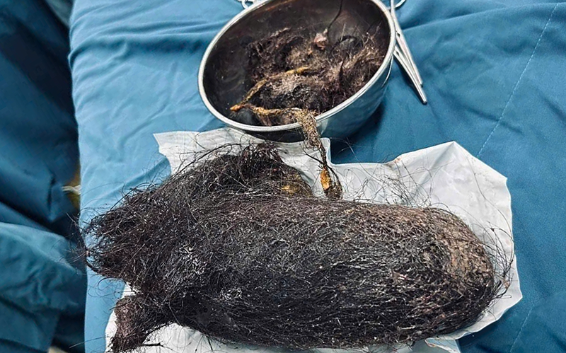 Bóc búi tóc khổng lồ nặng 900 gram được lấy từ trong dạ dày bé gái 12 tuổi ở Quảng Ngãi. Ảnh BVCC.