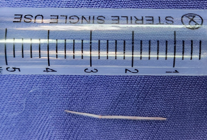 Chiếc xương cá dài 2,5cm được lấy từ sàn miệng bệnh nhân