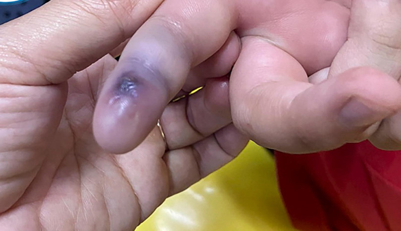 Vết cắn do rắn lục đuôi đỏ để lại (ảnh bệnh viện cung cấp) Vết cắn do rắn lục đuôi đỏ để lại (ảnh bệnh viện cung cấp)