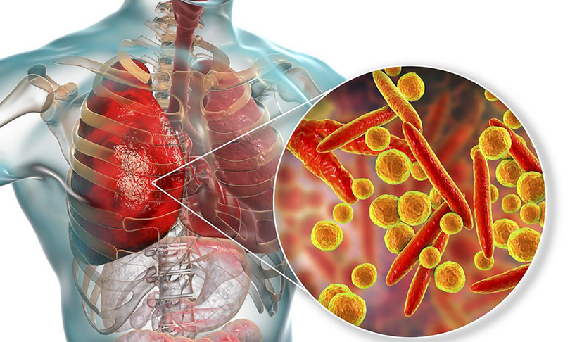 Virus Mycoplasma pneumoniae gây viêm phổi ở trẻ (ảnh BVCC)