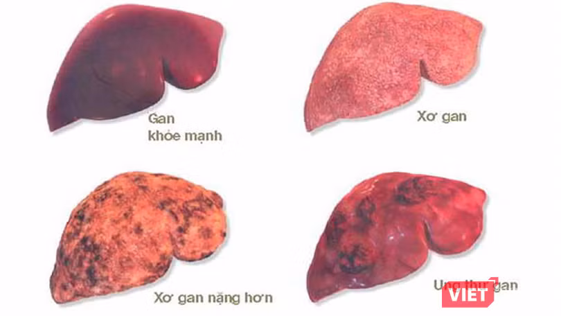 vt_ung thu gan 2.png