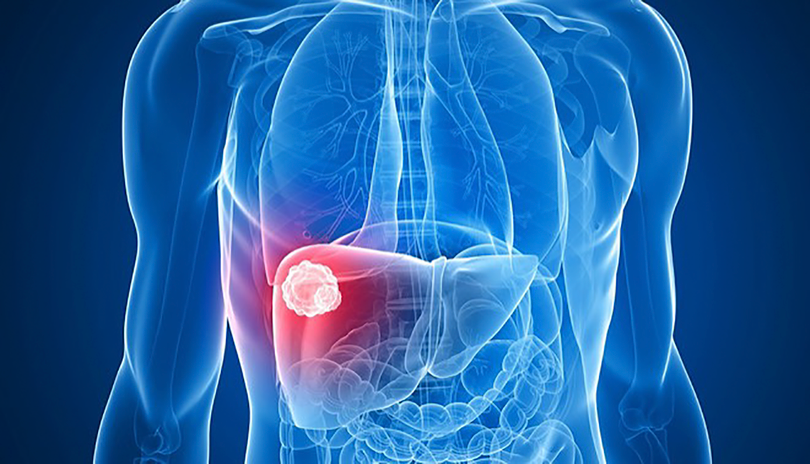 Ở Việt Nam, tử vong do ung thư gan gấp 3,8 lần tử vong do tai nạn giao thông (ảnh BVCC)