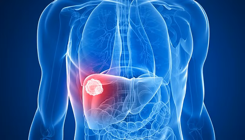Ở Việt Nam, tử vong do ung thư gan gấp 3,8 lần tử vong do tai nạn giao thông (ảnh BVCC)
