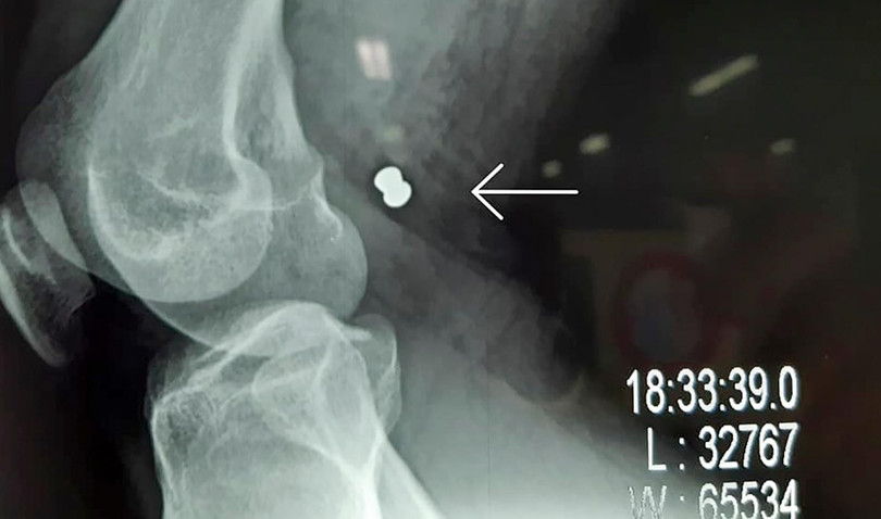 Phim X-ray chụp viên đạn ghim vào đùi gây vở động mạch và tĩnh mạch đùi của bạn nhân