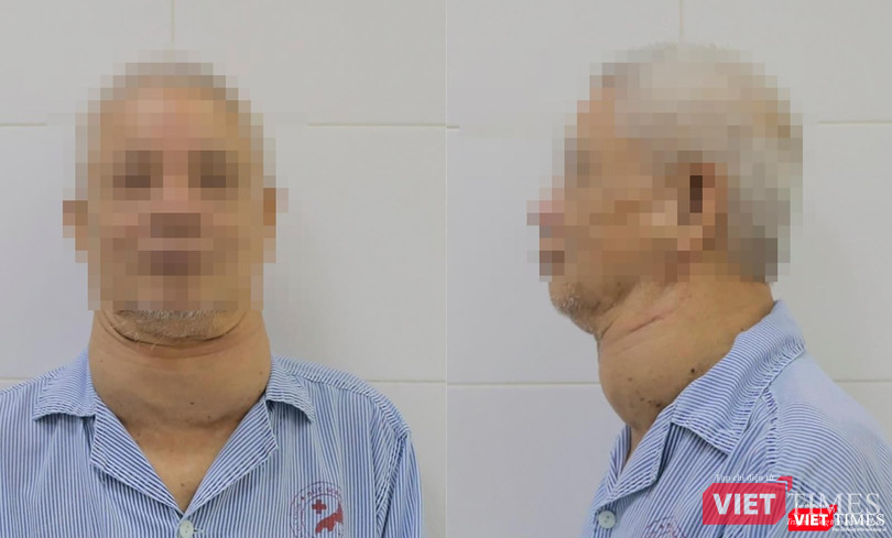 Khối u trên cổ bệnh nhân (ảnh BVCC) Khối u trên cổ bệnh nhân (ảnh BVCC)