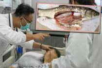 Một phụ nữ Trung Quốc đã nuốt túi mật cá sống với niềm tin rằng nó sẽ giúp giảm đau đầu, nhưng cuối cùng phải nhập viện cấp cứu do nhiễm độc. Ảnh: SCMP.