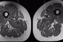 Hình ảnh chụp cộng hưởng từ (MRI) vùng đùi của một phụ nữ. Chế độ ăn của người này có đến 87% là thực phẩm chế biến sẵn. Ảnh: Hội X quang Bắc Mỹ.