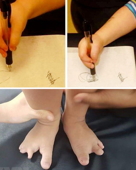 Hội chứng tay chân càng cua rất hiếm gặp 