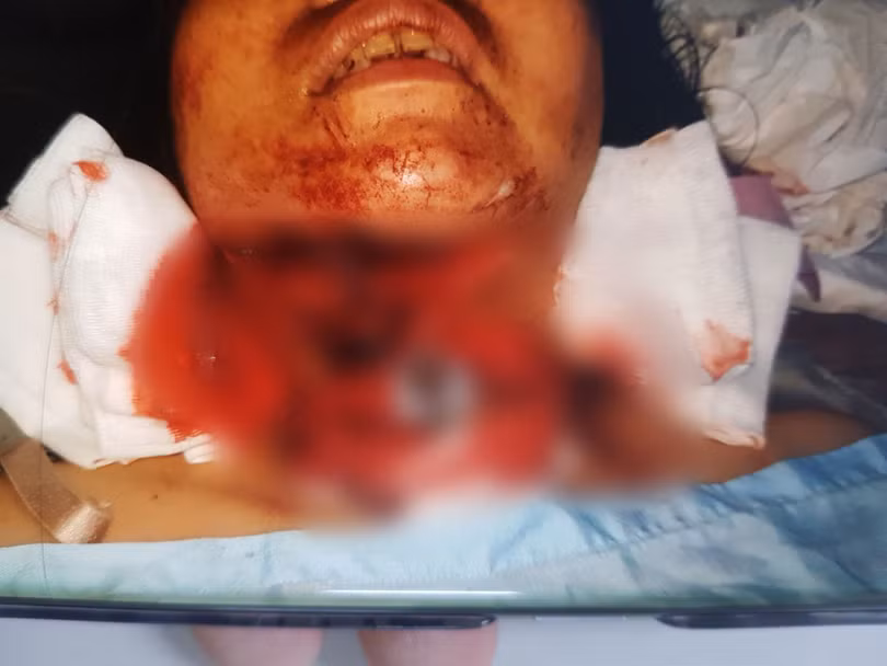 Chị P. bị chấn thương nặng ở vùng cổ