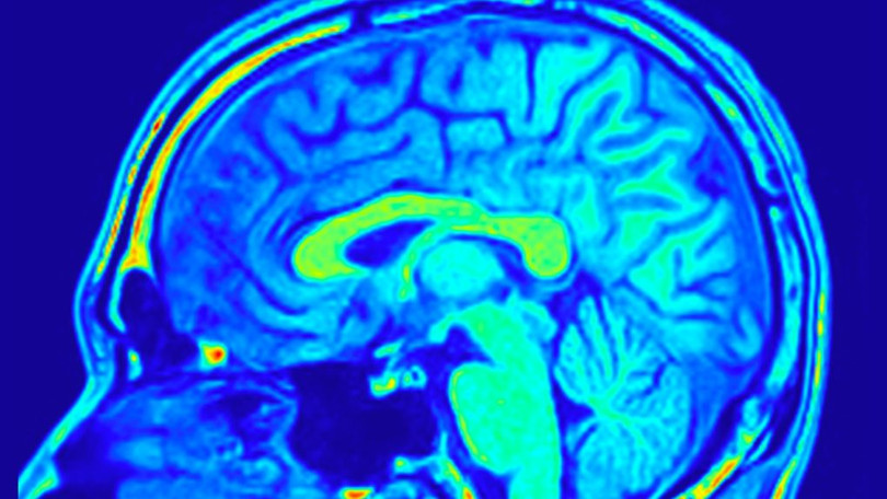 Hình chụp công hưởng từ não. Ảnh: FocalFinder/Shutterstock