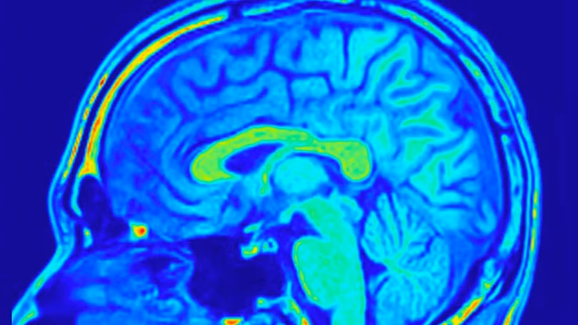 Hình chụp công hưởng từ não. Ảnh: FocalFinder/Shutterstock