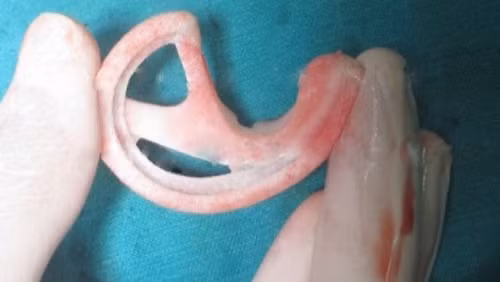 Khung vành tai nhân tạo