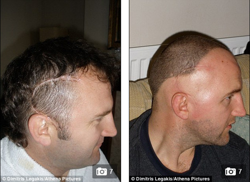 Bị ung thư não vì nghe điện thoại hơn 6 giờ mỗi ngày ảnh 3 Bị ung thư não vì nghe điện thoại hơn 6 giờ mỗi ngày ảnh 3