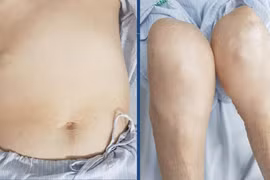 Bệnh nhân bị teo cơ tứ chi, béo bụng, rạn da vùng bụng, da mỏng, dễ xuất huyết vì lạm dụng corticoid để trị đái tháo đường. (Ảnh: BVCC) 