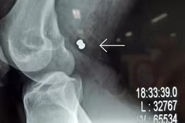 Phim X-ray chụp viên đạn ghim vào đùi gây vở động mạch và tĩnh mạch đùi của bạn nhân