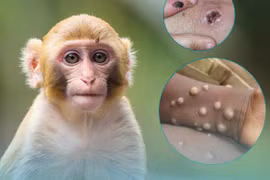 Bộ Y tế đề nghị các địa phương siết chặt giám sát bệnh đậu mùa khỉ (ảnh TH)