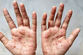 WHO công bố tình trạng khẩn cấp toàn cầu do bệnh đậu mùa khỉ lần thứ hai 
