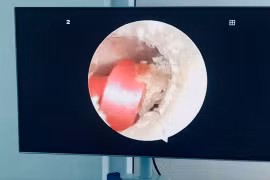 Sợi dây buộc tóc suýt làm bé gái 6 tuổi thủng màng nhĩ