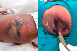 Em bé sơ sinh bị bỏng nặng, hoại tử da vì mẹ cho nằm than