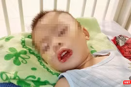 Bé trai không may bị uống nhầm thuốc tẩy bồn cầu, dẫn tới loét miệng và thực quản, dạ dày (Ảnh: BVCC) 