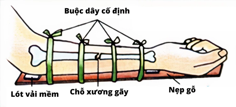 cac_buoc_so_cuu_va_bang_bo_cho_nguoi_gay_xuong_cang_tay_3_3b78485970.png