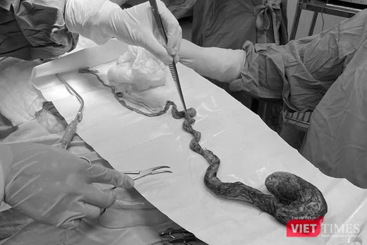 Búi tóc lấy ra từ dạ dày bé trai 6 tuổi