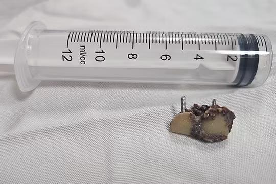 Chiếc răng giả ở trong phổi bệnh nhân 20 năm vừa được các bác sĩ Bệnh viện Đà Nẵng lấy ra.