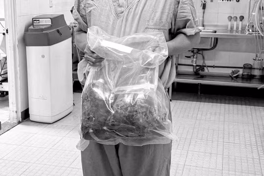 Khối u thận đa nang nặng gần 10 kg được lấy ra từ cơ thể bệnh nhân.