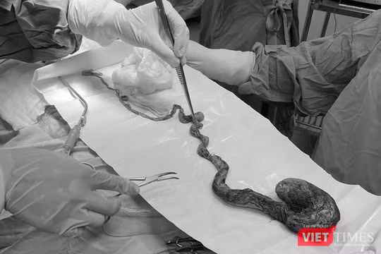 Búi tóc lấy ra từ dạ dày bé trai 6 tuổi