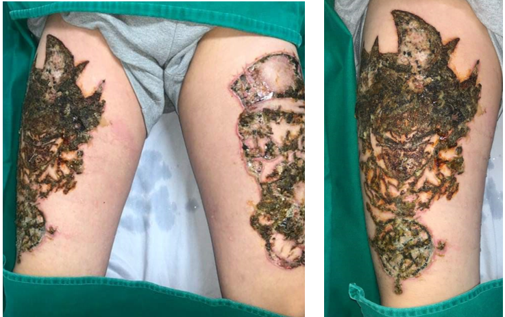 Xóa xăm ở cơ sở không an toàn dẫn đến nhiễm trùng nặng (ảnh: Lê Vinh)