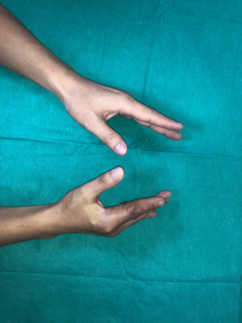 sau mổ 4 tuần.JPG