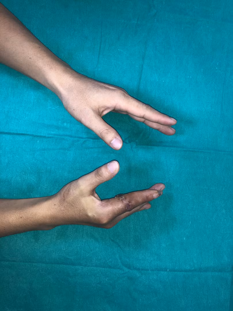 sau mổ 4 tuần.JPG