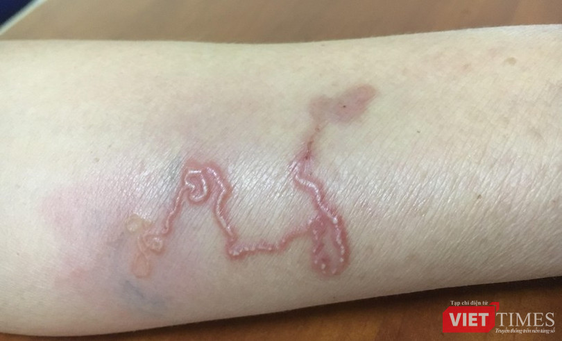 VT_ giun chó mèo.jpg