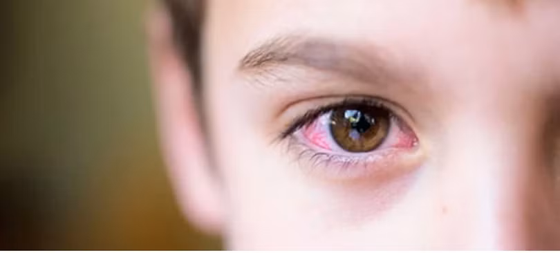 Dịch đau mắt đỏ đang bùng phát 