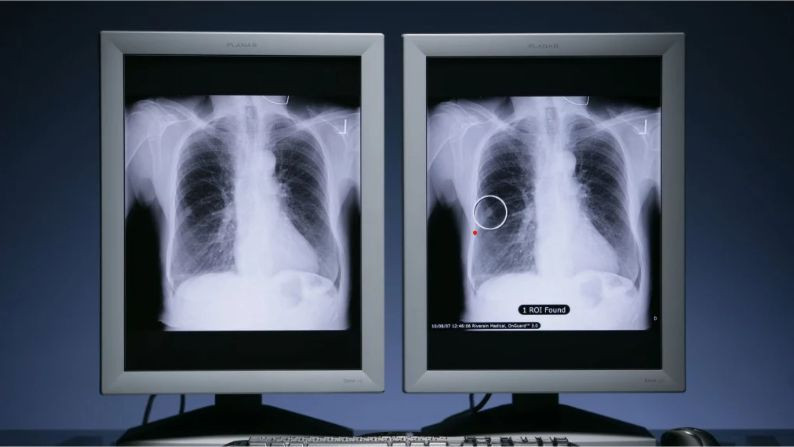 Ung thư phổi là loại bệnh phổ biến nhất trên toàn thế giới, ước tính có 2,5 triệu ca mới trên toàn cầu vào năm ngoái. Ảnh: PR NEWSWIRE.