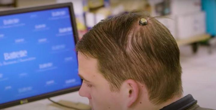 Giao diện não-máy tính yêu cầu một con chip cấy vào não. Ảnh: Bloomberg Giao diện não-máy tính yêu cầu một con chip cấy vào não. Ảnh: Bloomberg