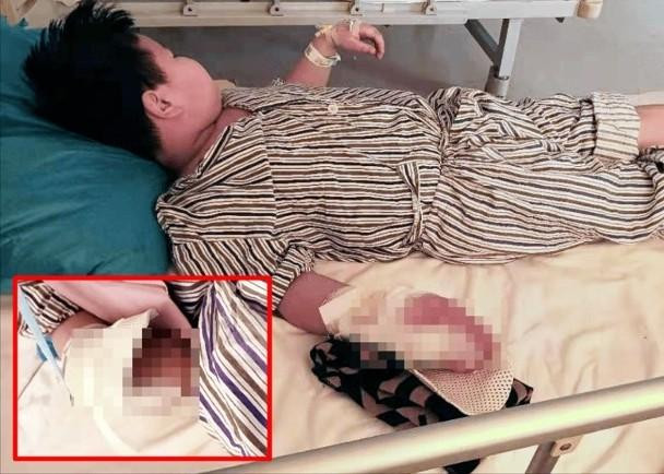 Chú bé Tiểu Hồng ở Liêu Ninh bị nát bàn tay phải do pháo (Ảnh: Đông Phương).