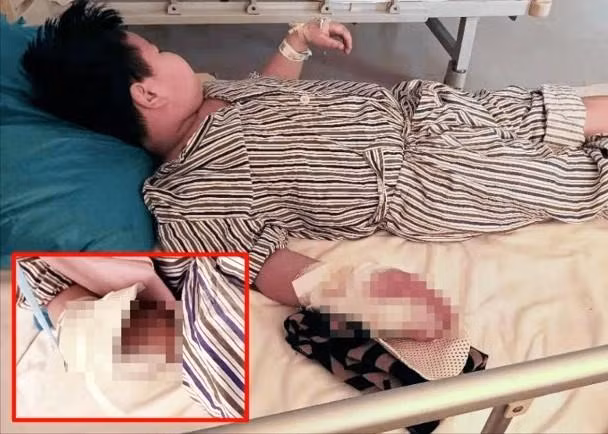 Chú bé Tiểu Hồng ở Liêu Ninh bị nát bàn tay phải do pháo (Ảnh: Đông Phương).